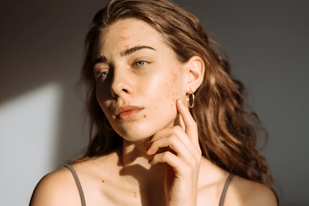 A woman needs Acne Care in Flatbush